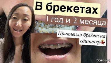 ПРИКЛЕИЛИ БРЕКЕТ НА ЕДИНИЧКУ💃 1 ГОД И ДВА МЕСЯЦА В БРЕКЕТАХ✍️