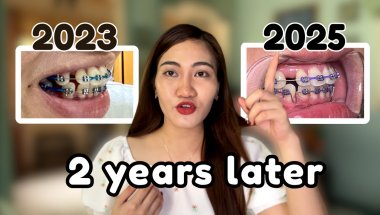 What Happened after my Premolar Extractions ?