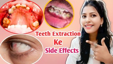 दांत निकलवाने से क्या नुकसान होता है? | Teeth Extraction Ke Side Effects 😨 #braces #bracesjourney
