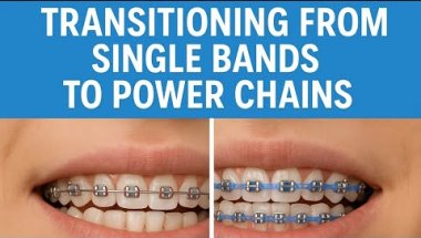 Braces update! Getting power chains, how they feel, and how to deal with the discomfort of braces