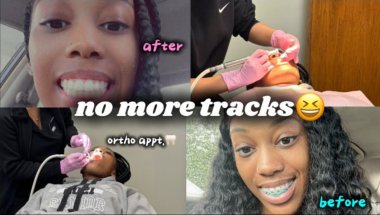 vlog: getting my braces removed!😁