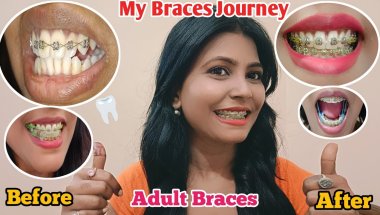 My Braces Journey ||Adult Braces 2025/ Braces Update/#braces #bracesjourney #trending Nd Family Vlog