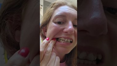 Épisode #2 Mes impressions sans filtre avec les aligneurs invisalign  jour 1.