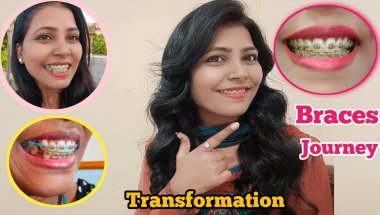 BRACES JOURNEY | BRACES TRANSFORMATION / Before & After #USA