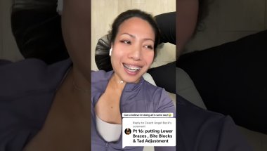 In Same Day I Did Lower Braces, Bite Block & TADs Addjustment Experience