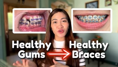 Why Your Gums Matter More Than You Think With Braces!