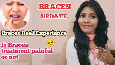 Adult Braces Update || Braces Experience / Braces vlog