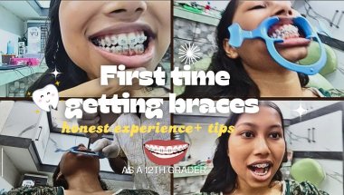 My First Time Getting Braces 😬 | Honest Experience + Tips🦷#braces#vlog#minivlog #bracestreatment#fyp