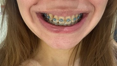 Braces Tour | How My Teeth Are Looking After Two Years | Adult Braces Journey