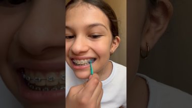 Putting On & Taking Off Braces Bands... in EVERY Color!