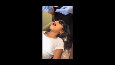 Getting my top braces done✨
