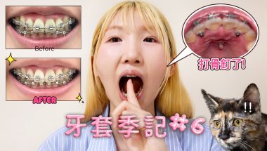 牙套季記 #6🦷終於打骨釘了😵!! 其實沒那麼可怕😮‍💨阿宣的牙套竟然快畢業了 請各位幫她健檢一下🤣｜白 @xx.bb.ai