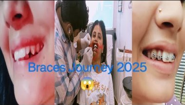 My Braces Journey 2025😱 #braces
