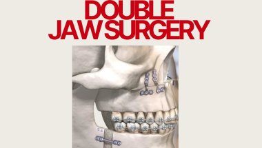 Double Jaw Surgery - Part 1: Finding a surgeon and getting braces