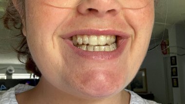 Day 4 wearing my Invisalign