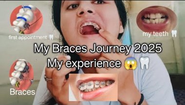 😮🦷 Braces Journey 2025|| #mybracesjourney #bracesexperience