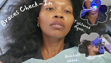 How Brackets Are Put On Teeth| New Braces Check-Up + Update 🪥💕 #braces #newsmile