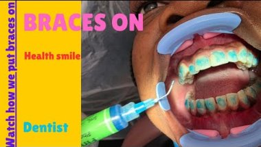 PROCESS OF GETTING BRACES