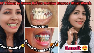 🦷Top 10 Tips Before Getting Braces 😨 ll My Braces experience Cost, Pain, Braces Hurt Smile Result 😍