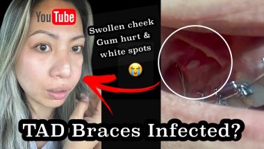 My TADS Braces Got Infected? Cheek Swollen & Gums Hurt! Went to my Orthodontist For Checkup