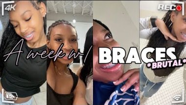My FIRST WEEK of having BRACES! *lightforce edition
