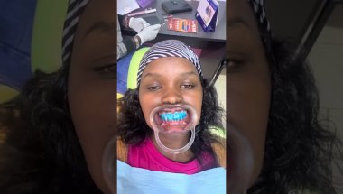 Braces installation