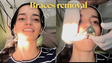 I got my BRACES removed 🦷| Painful? 😥 | Braces Removal Process