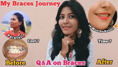 🦷😨Braces Vlog ll Braces Update l Adult Braces  Cost,Type of Braces, Pain 2025 l Q&A All About Braces