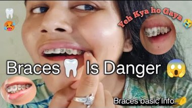 🦷🥺 Braces Is Danger 😱 || My Braces Journey Experience #bracesproblem