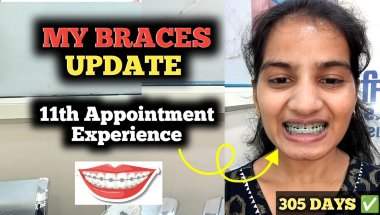 Nearly There: My Braces Journey Update!