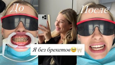 Сняла брекеты спустя 2 года и вот как я теперь выгляжу!