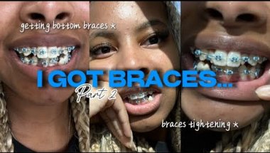 I GOT BRACES!! part 2 | got my bottom braces + my first braces tightening!!!! | Brya Life