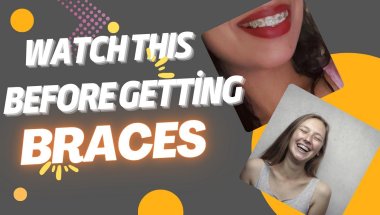 Important tips to know before getting braces ( my personal experience)