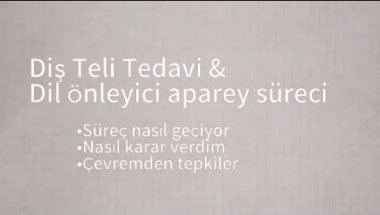 Diş Teli ve Dil Önleyici Aparey sürecim | Nasıl karar verdim ?