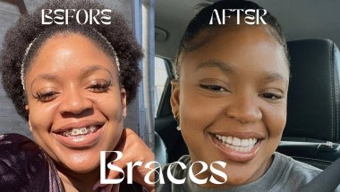 Braces Journey Before & After | Getting My Braces Off Transformation