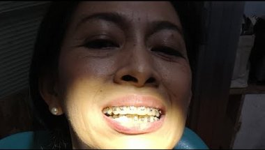 Braces Adjustment (Continuation) & Splint Adjustment