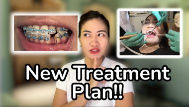 Braces Update for August Will Surprise You! | Ligature wires | TADs etc.