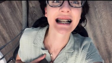First Braces Adjustment After 2nd Exposure Surgery