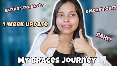 Week 1 with braces — patience today, perfect smile tomorrow.✨🦷