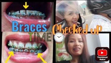 29mths Braces Updates july 2025 | Change o-ring, Powerchain,cutting teeth #adultbraces #braces
