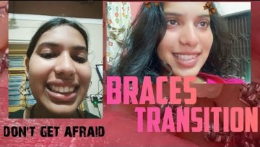 Braces journey and tooth extraction ..!!!  #braces #smile #transition #orthodontics #retainers