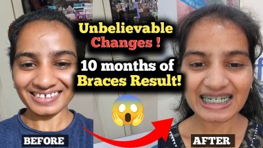 Worth the Pain : My 10-Months Braces Results!😁