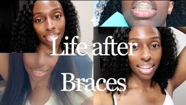 Life after Adult Braces| My Hawley Retainer