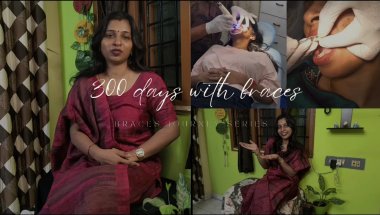 300 days of braces journey | pain | Braces cost|consultation| all about braces | halfway through 🥰