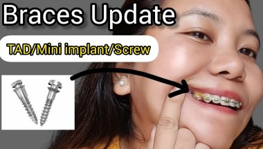 My Braces update || TAD /Mini implant/Screw || Procedure #braces #bracesjourney #transformation