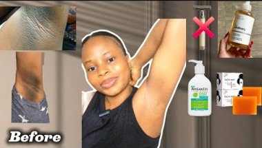 Realistic ways i got Rid of my Dark Underarms for good/ Tested and trusted method