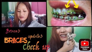 30mths Braces Updates August 2025 || braces checked up,braces update #braces #bracesupdate