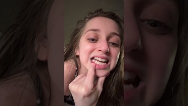 Shauna Rae: Invisalign Day 10