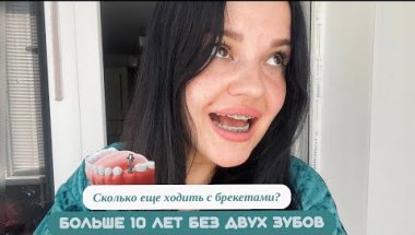 Что мне сказал стоматолог ? имплантация зубов, наращивание костной ткани и боль