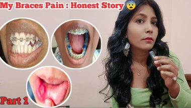 My Braces Pain : Part 1 Honest Story 😨 ll My Braces Pain : UNFILTERED Story (Sept 2025 Update)